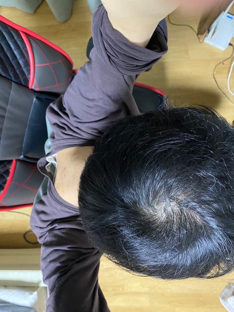 3.9일탈모2.jpg