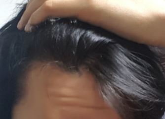왼쪽이마입니다