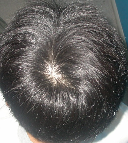 1치료전.jpg