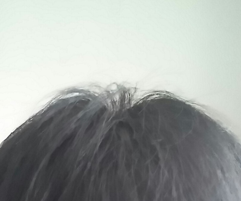 탈모4.jpg