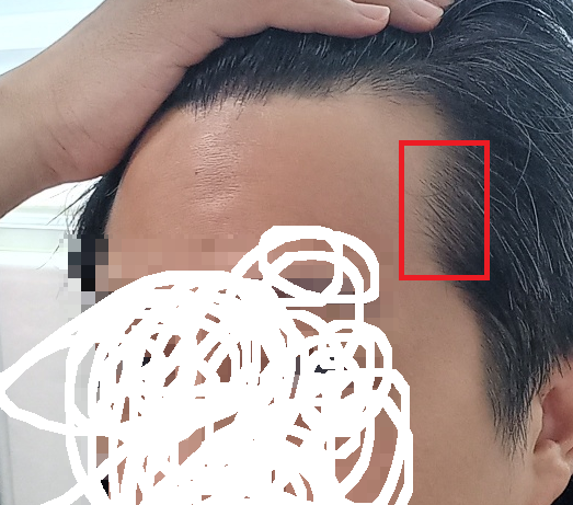 탈모1.png