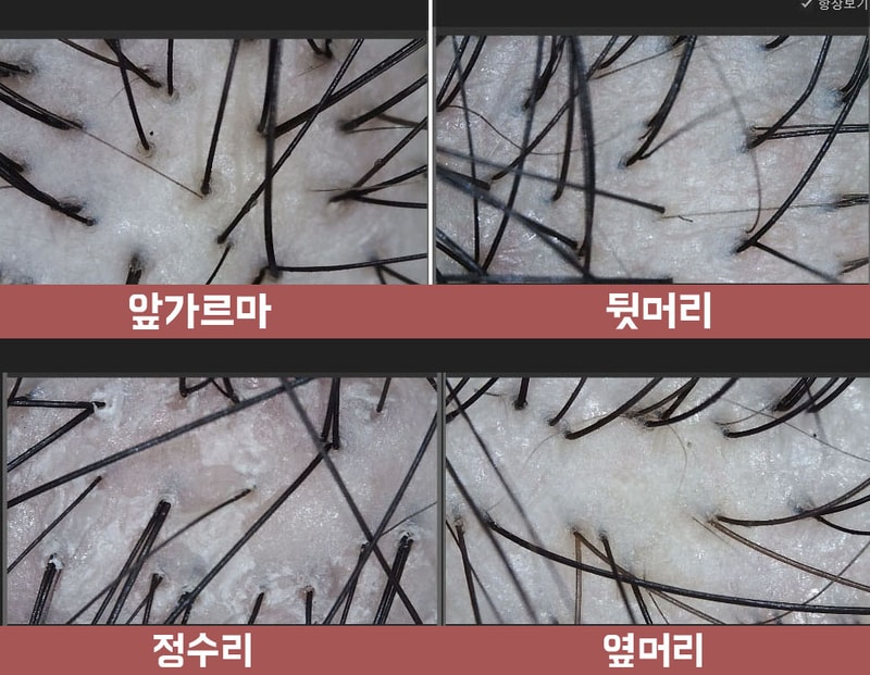 20160218 - 두피.jpg