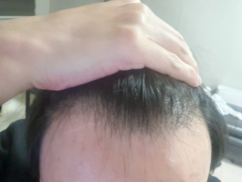 M자 탈모 진행 중