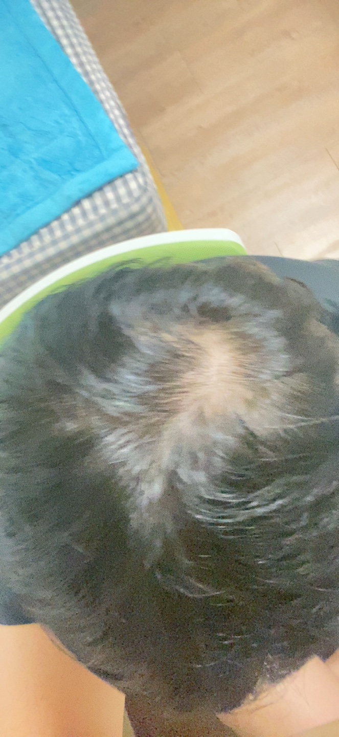 탈모인가요?