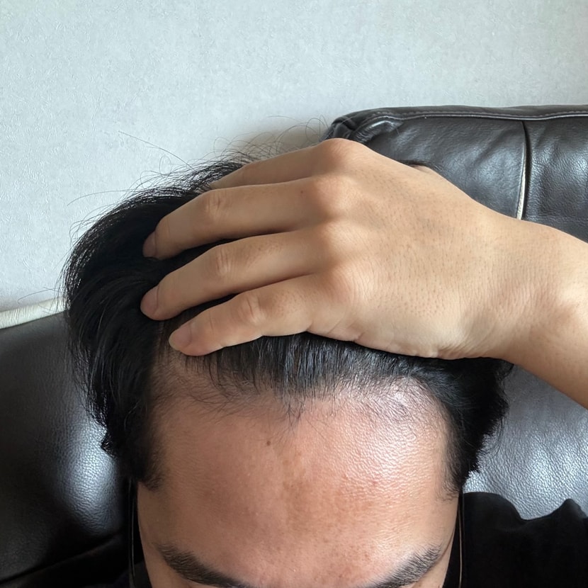 이마 깐 사진