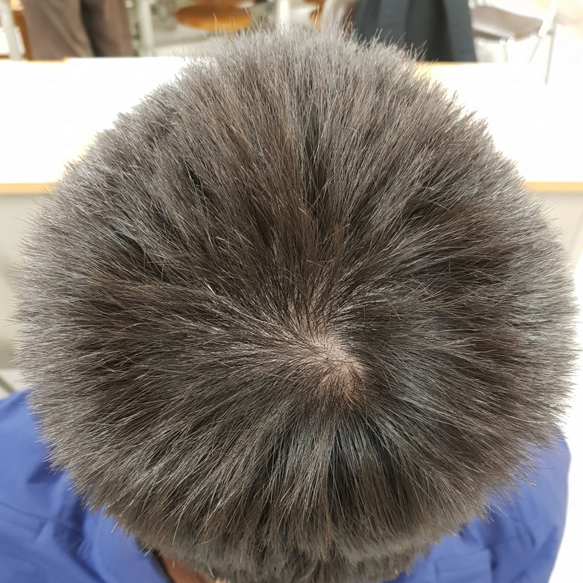 23년 10월 25일 머리 정수리 상태