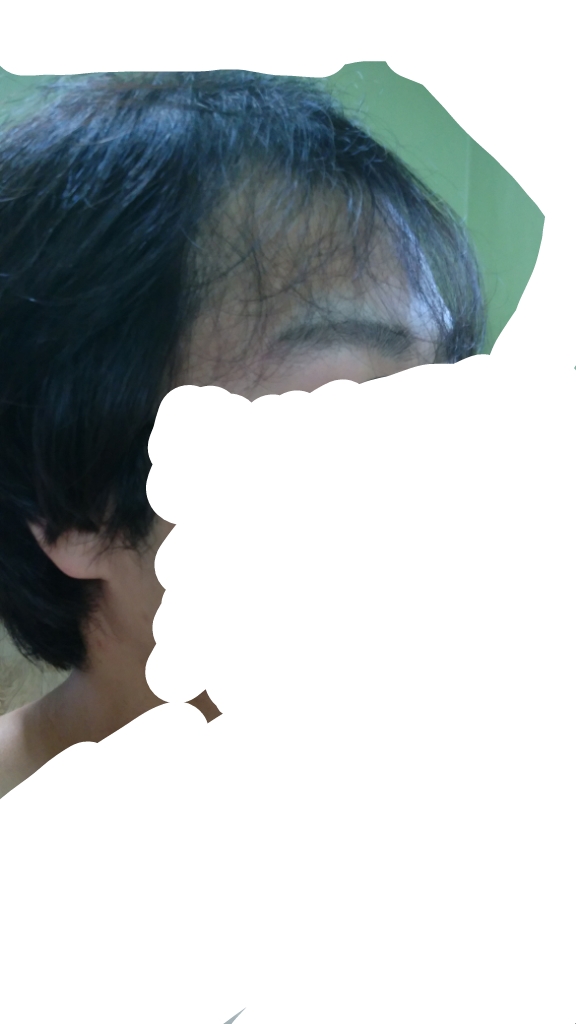 탈모1.jpg