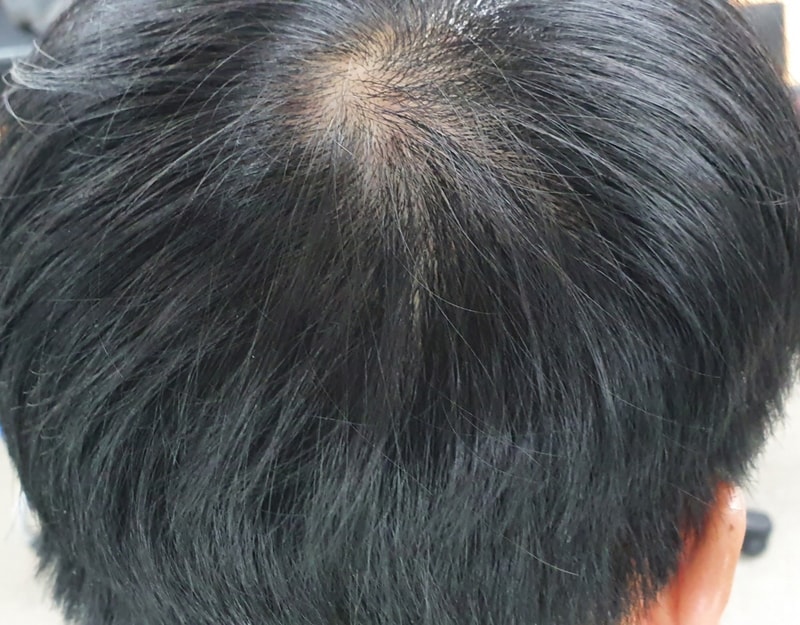 정수리 사진 4.jpg