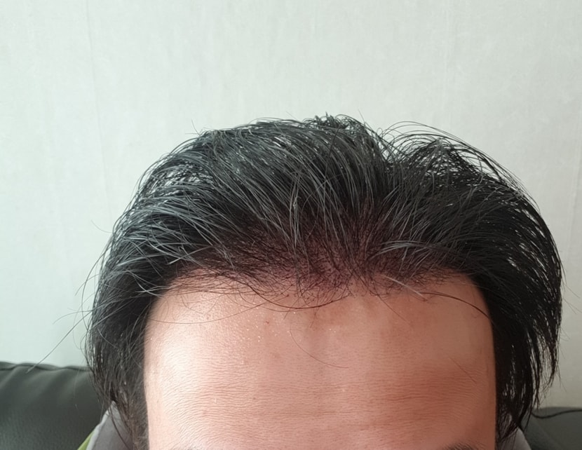 탈모 상태 및 최근 수술 직후 사진