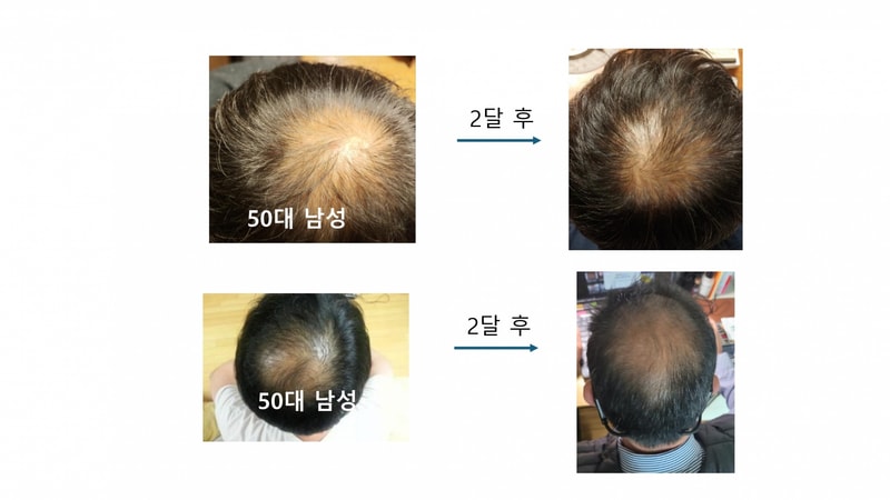헤어토닉 임상사례_page-0004.jpg