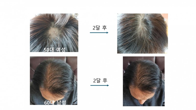 헤어토닉 임상사례_page-0003.jpg