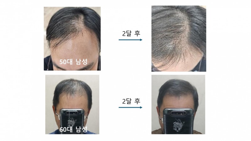 헤어토닉 임상사례_page-0002.jpg