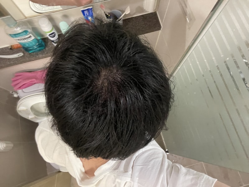 탈모인가요… 이거