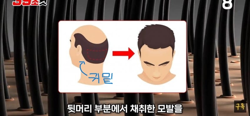 이식모는 안빠지는거맞나요?? 비절개에 대한 비판적시각  전문가님 와주세요