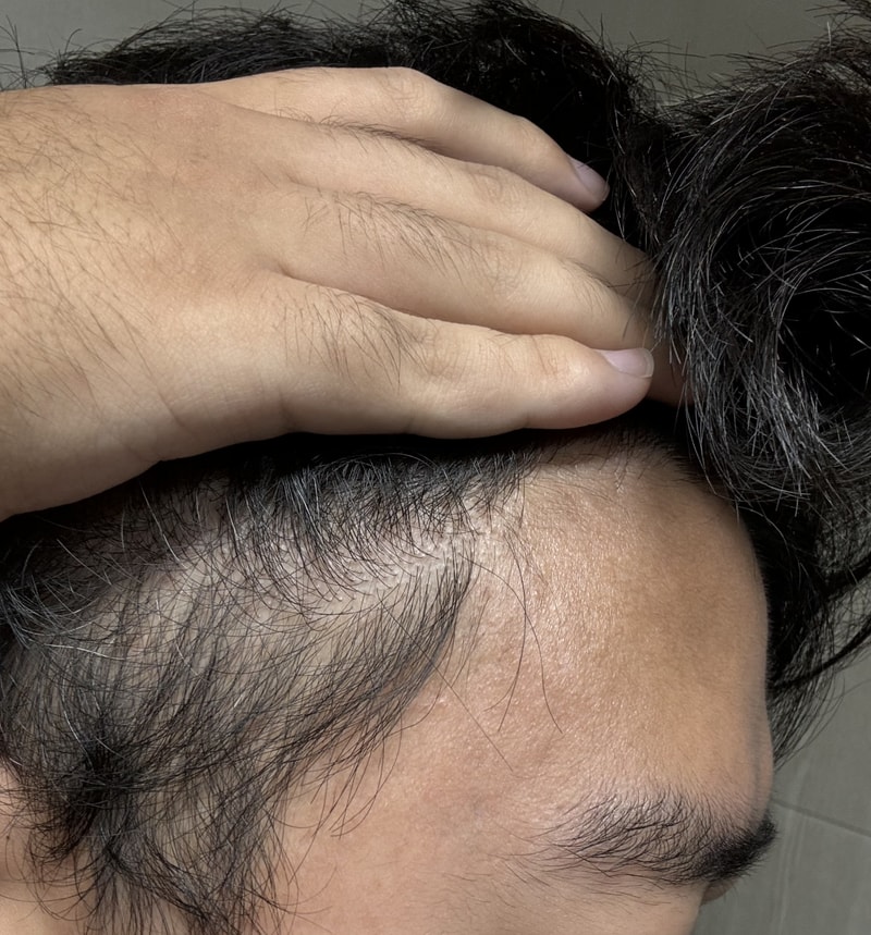 頭皮薄毛症で合ってますか？ どうか見てくださればありがたいです..