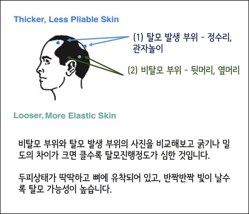 탈모인가 아닌가 002.jpg