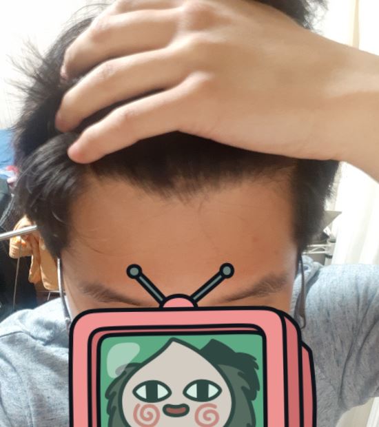 이마.JPG