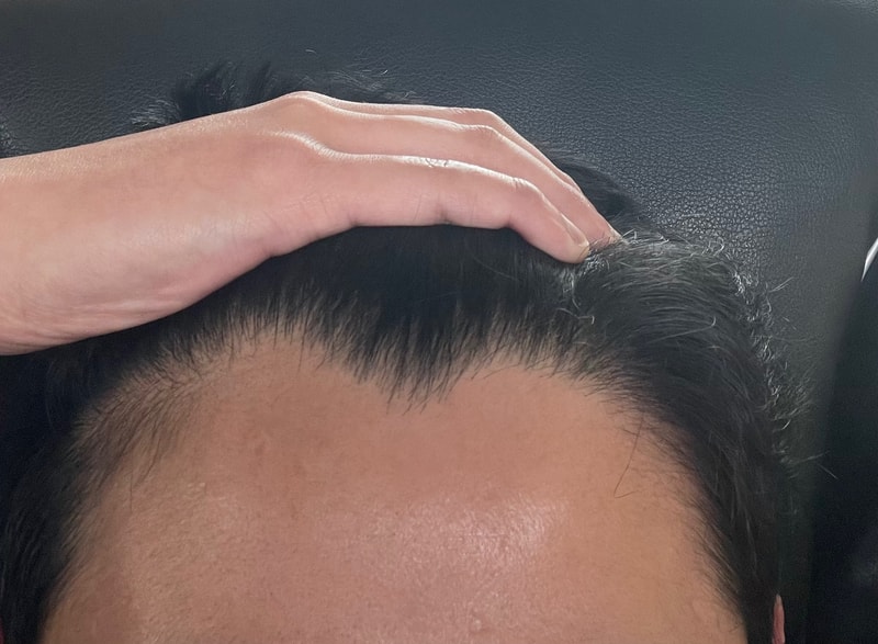 탈모2.jpg