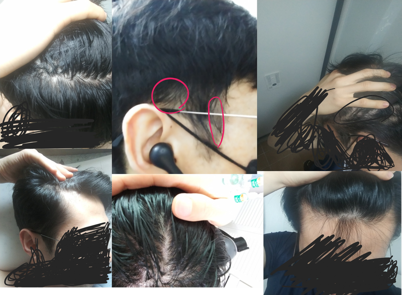 탈모.png