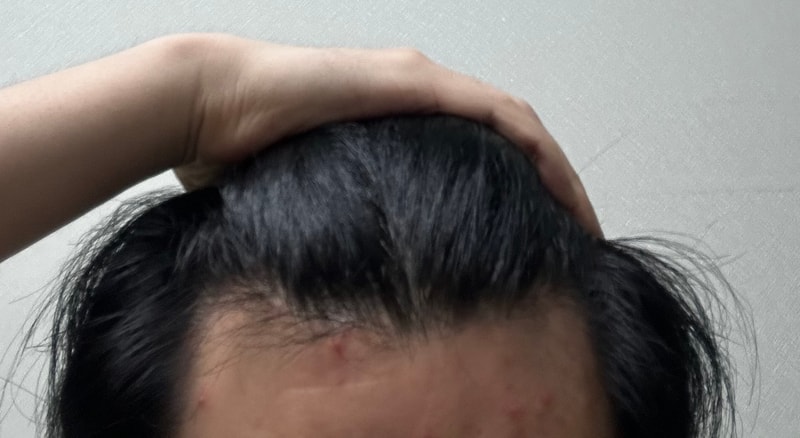 가족력은 무시할 수 없습니다..