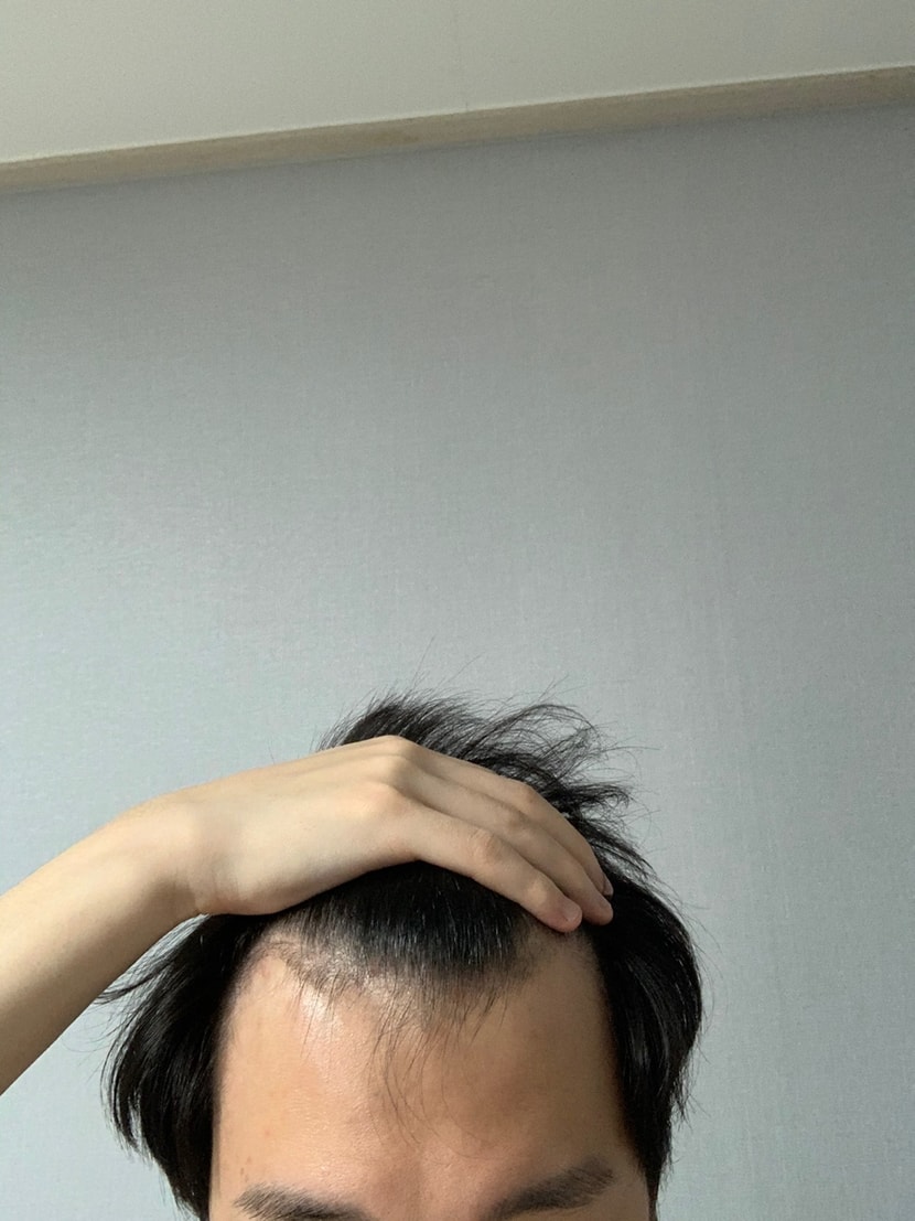눈감고 최대한 멀리서찍은 현실 M자 상태