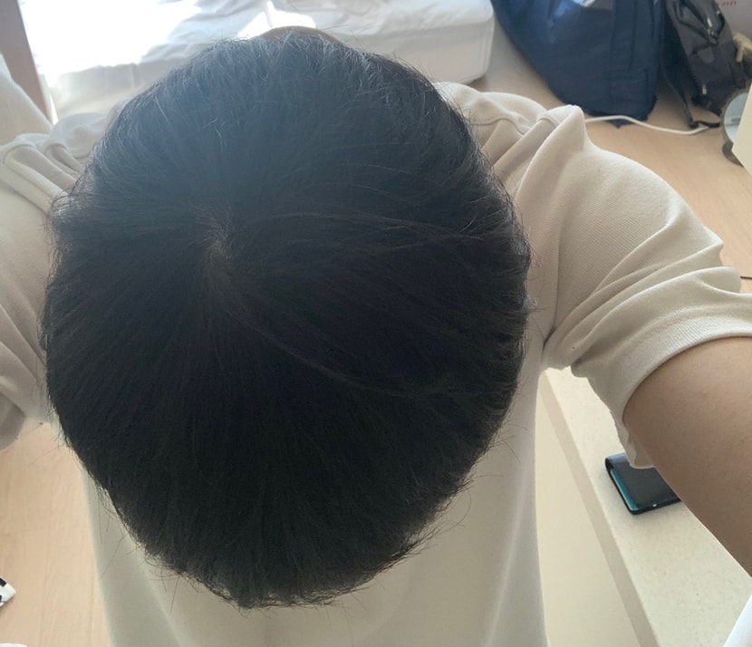 정수리 상태