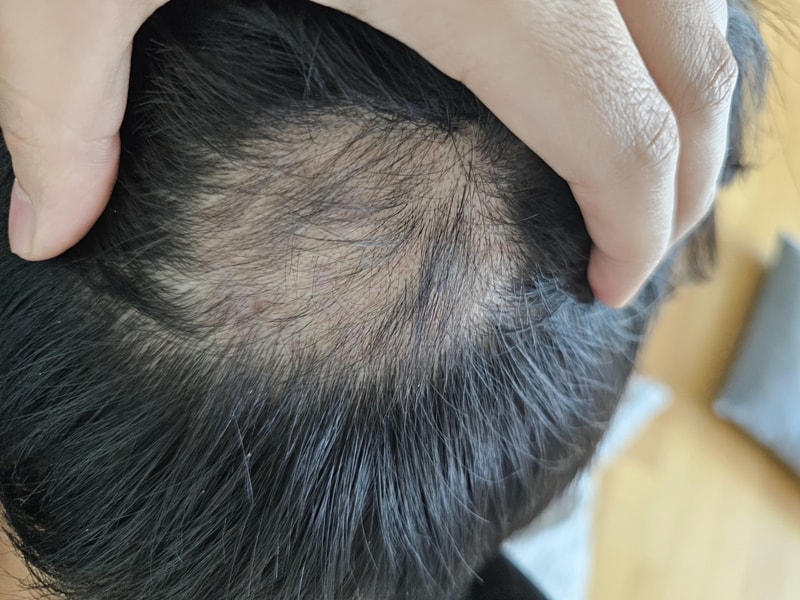 원형탈모 이정도면 회복된다고 봐도 될까요?