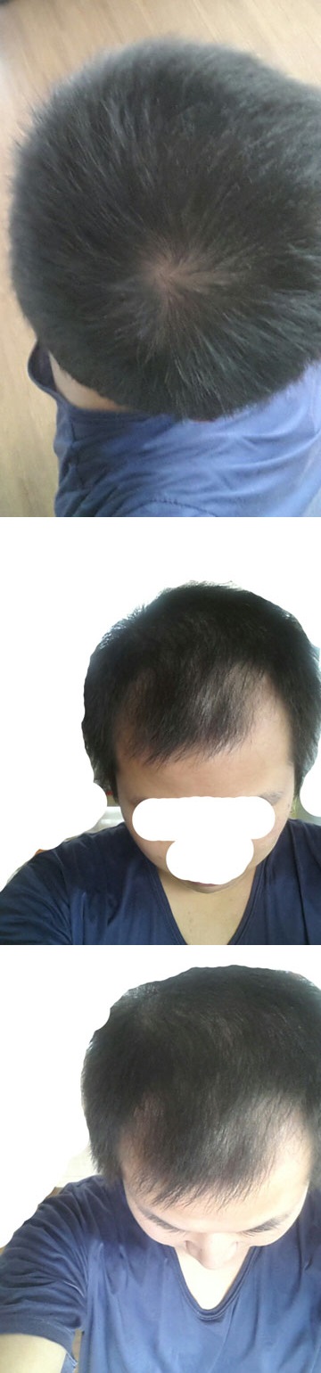 탈모1-vert.jpg