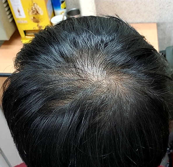 alopecia-20171105-010552-000.jpg