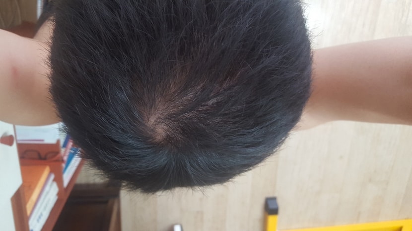 반삭전 어제 머리감기전 빗질로 최대한커버