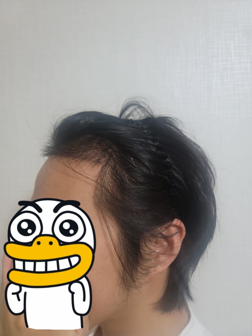 모발이식 후