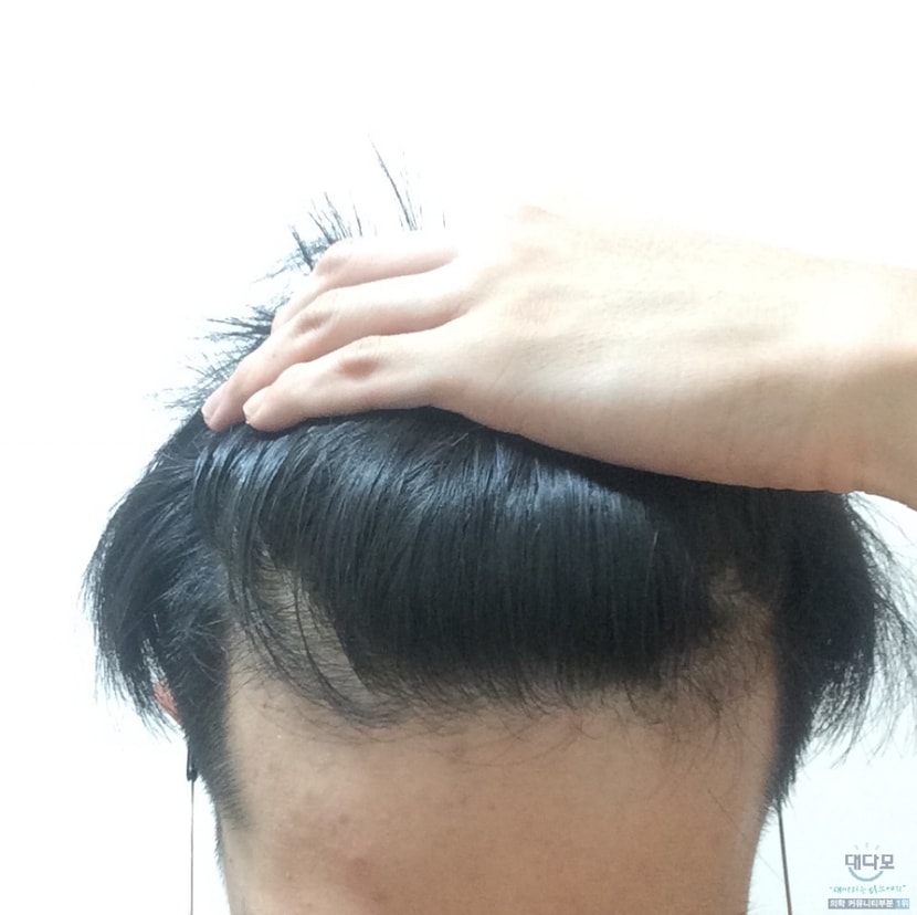 예전 이마 