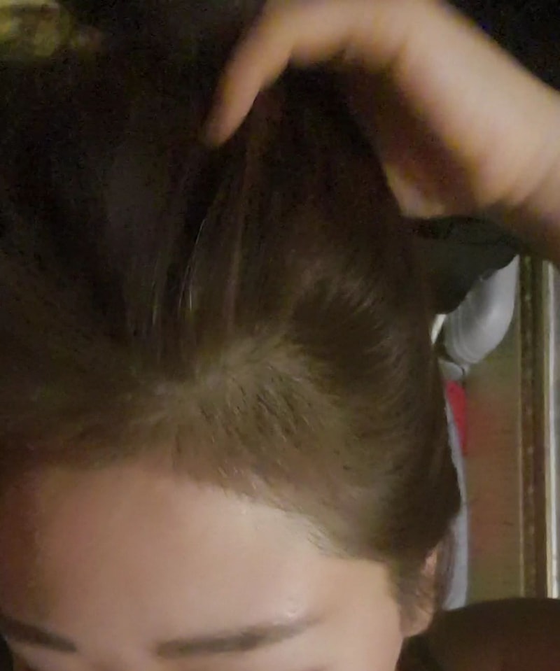 alopecia-20200225-184031-002.jpg