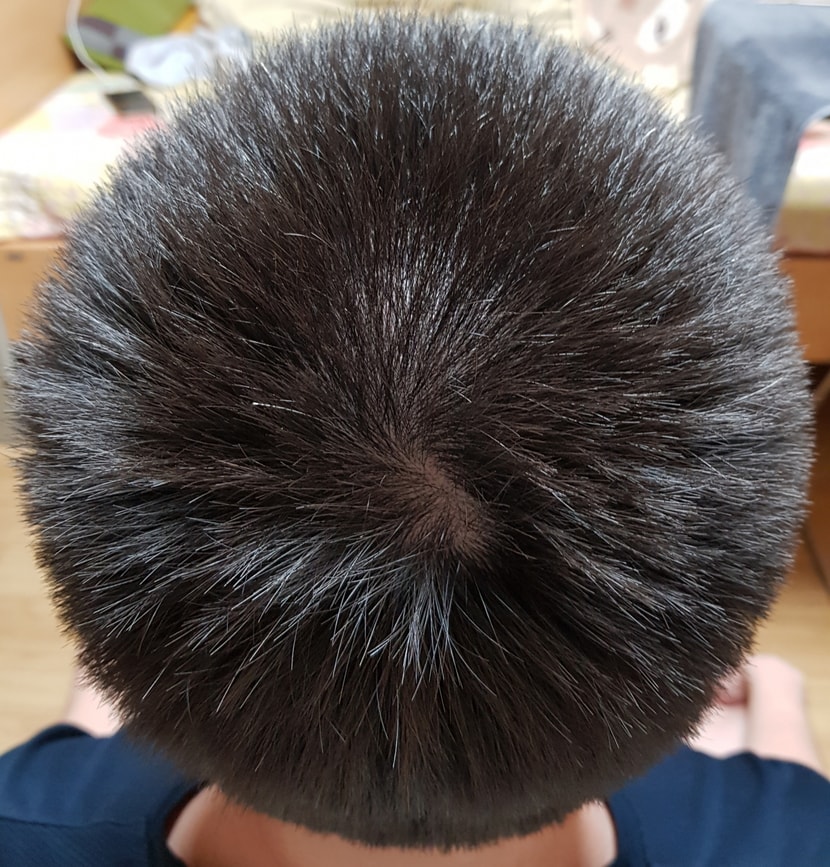 정수리1