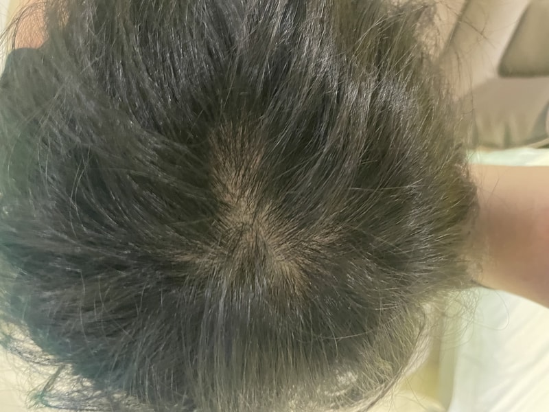 탈모 맞는거죠??…