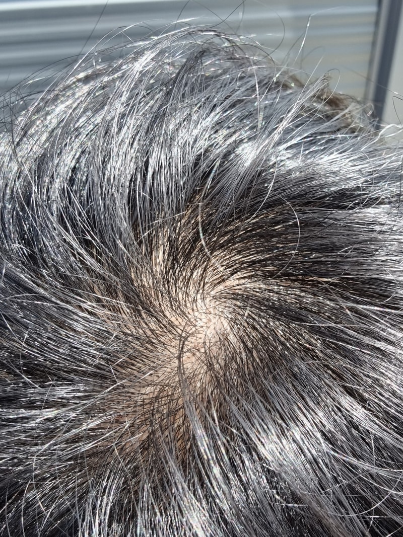 alopecia-20220322-175859-000.jpg