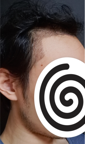 수술 후 2