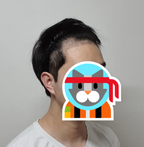 이치훈 후 2.PNG