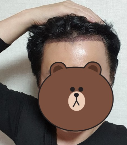 이경찬 수술 1일차 3.PNG