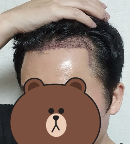 이경찬 수술 1일차 2.PNG