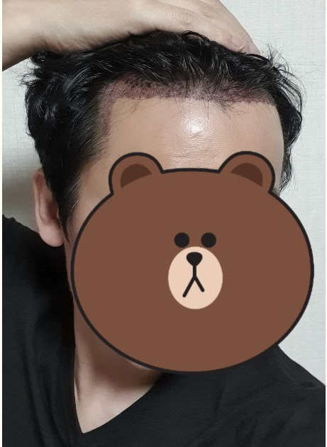 이경찬 수술 1일차.PNG