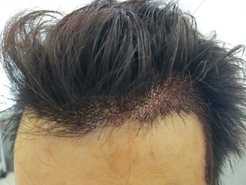 수술후 밀도