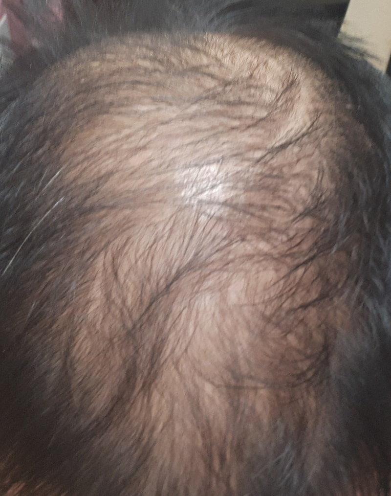 alopecia-20200420-194458-000.jpg