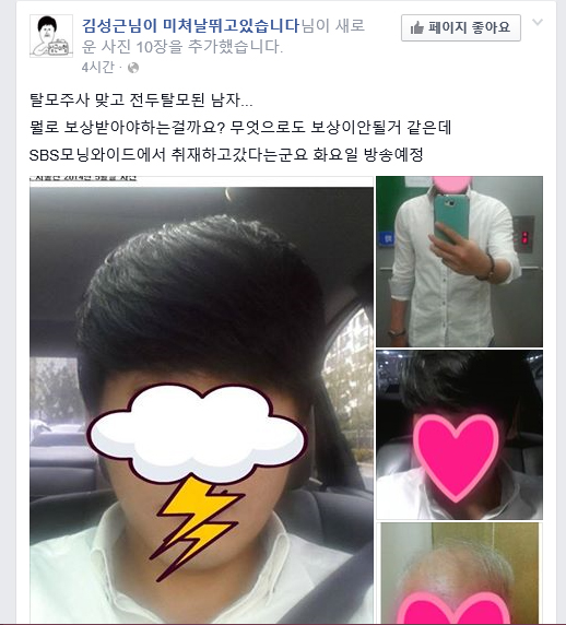 전두탈모.jpg