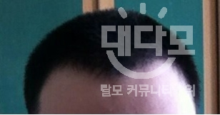 탈모1.jpg