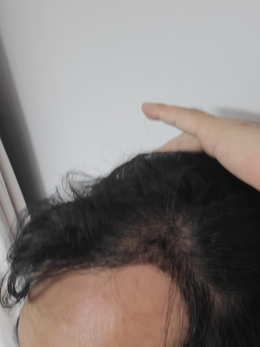 수술후