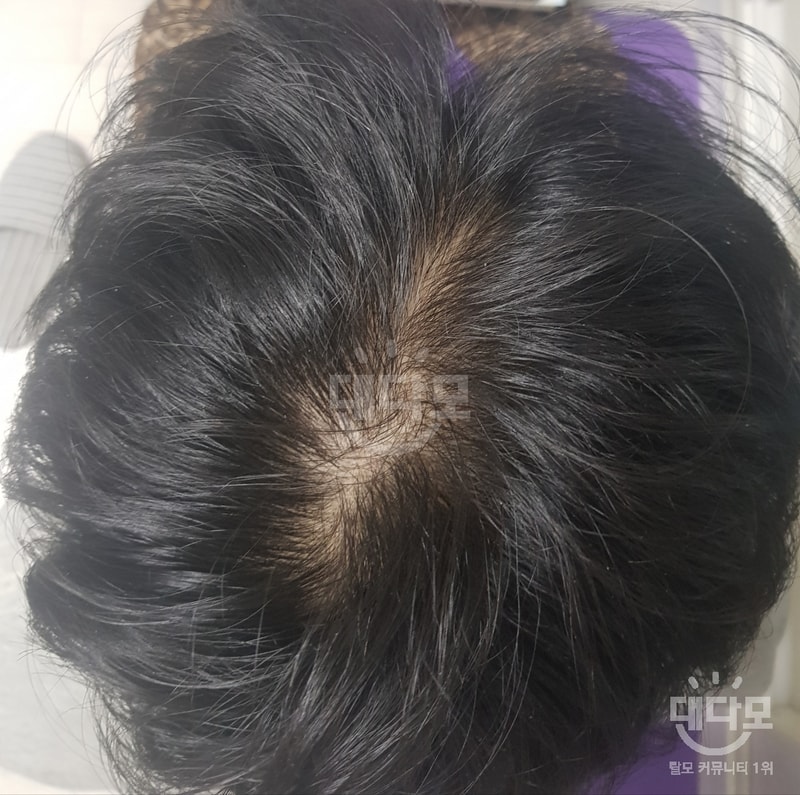 alopecia-20190914-211847-000.jpg