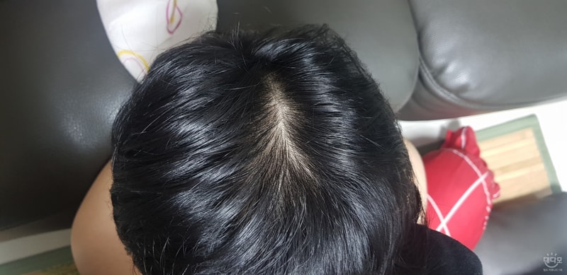 alopecia-20190914-211849-001.jpg