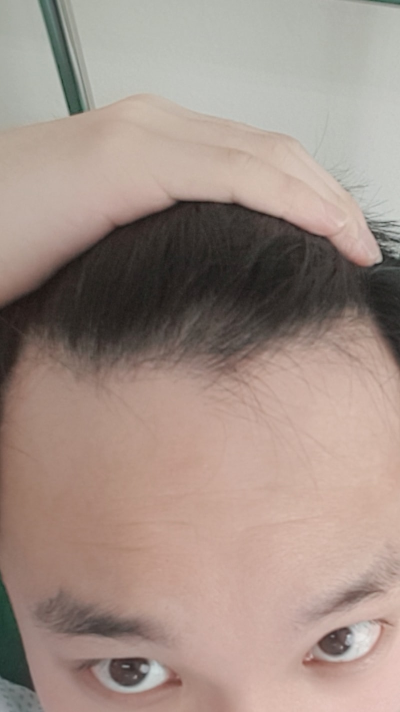 alopecia-20191217-221350-000.jpg