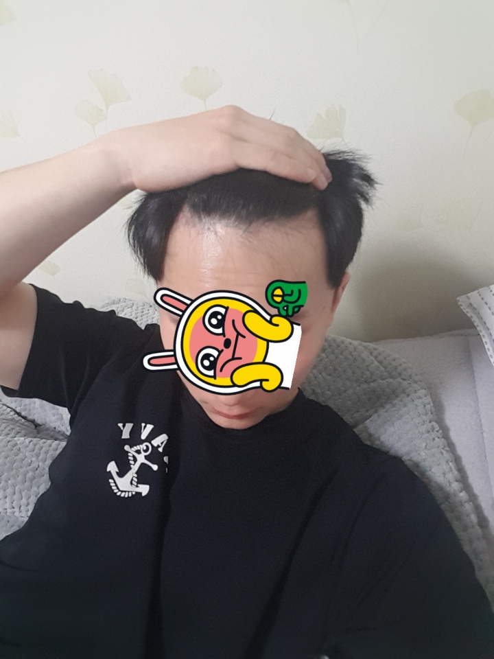 alopecia-20191217-221505-000.jpg